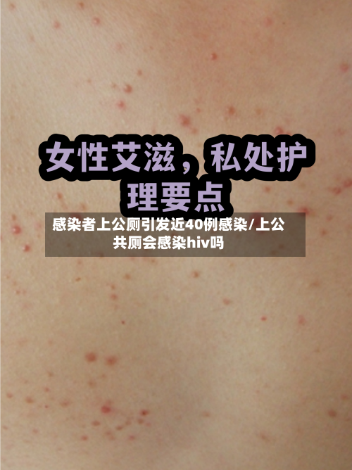 感染者上公厕引发近40例感染/上公共厕会感染hiv吗-第2张图片