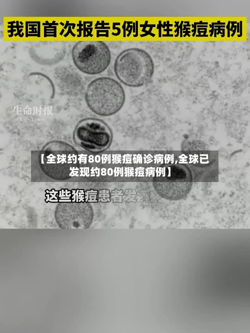 【全球约有80例猴痘确诊病例,全球已发现约80例猴痘病例】